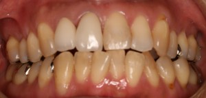 　錦織②-2　右上12OS装着